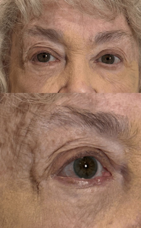 Basal Cell Carcinoma Right Lower lid Resection of tumor and Repair by Adjacent Tissue Transfer, Reconstruct Lower Lid and Lateral Canthus After