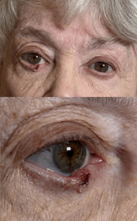 Basal Cell Carcinoma Right Lower lid Resection of tumor and Repair by Adjacent Tissue Transfer, Reconstruct Lower Lid and Lateral Canthus Before