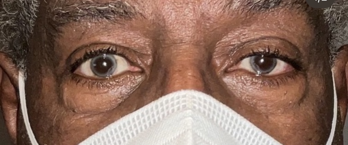 Left Ptosis Repair Before