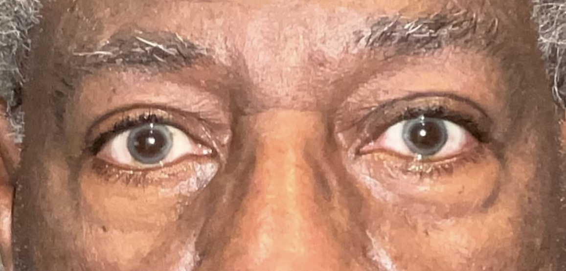 Left Ptosis Repair After