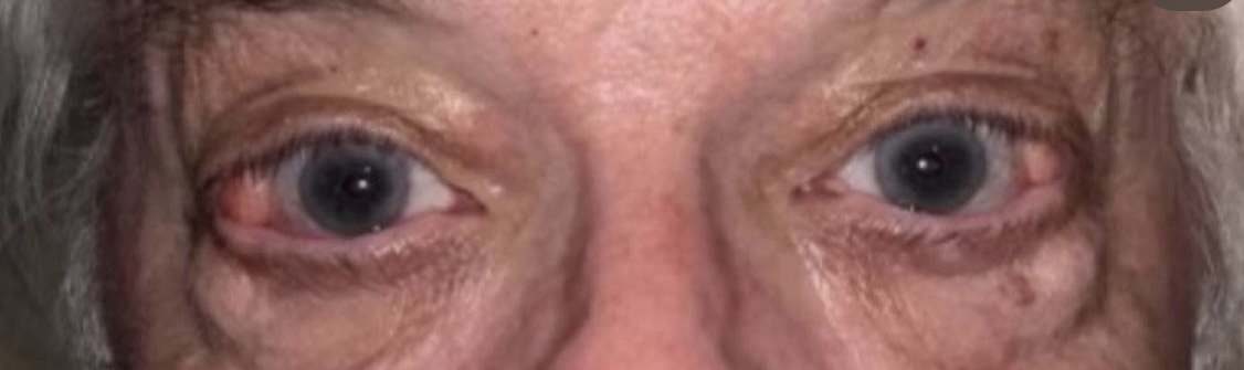 Orbital Fat Removal Before