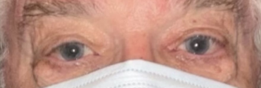 Orbital Fat Removal After