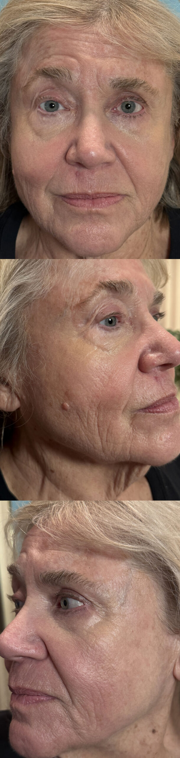 Laser Skin Resurfacing - CO2 laser Full Face After