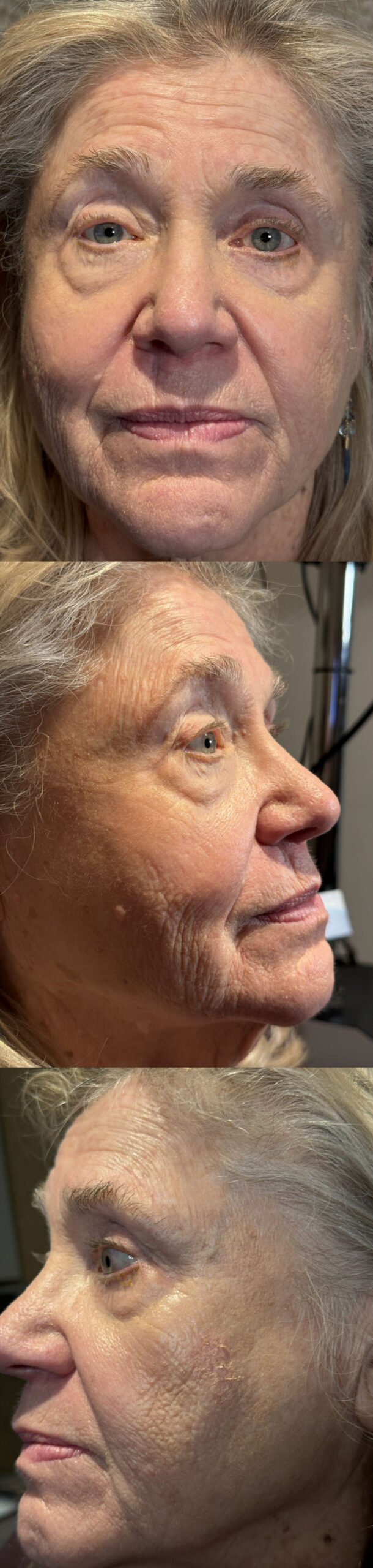 Laser Skin Resurfacing - CO2 laser Full Face Before