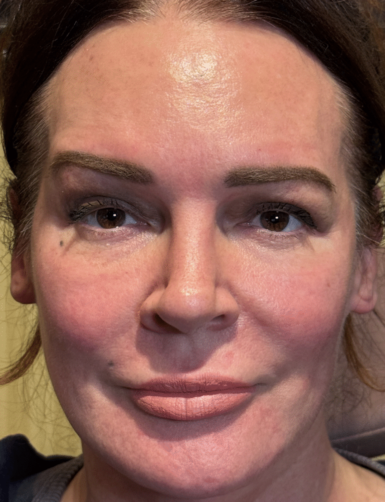 FULL FACE FRACTIONAL ABLATIVE CO2 After