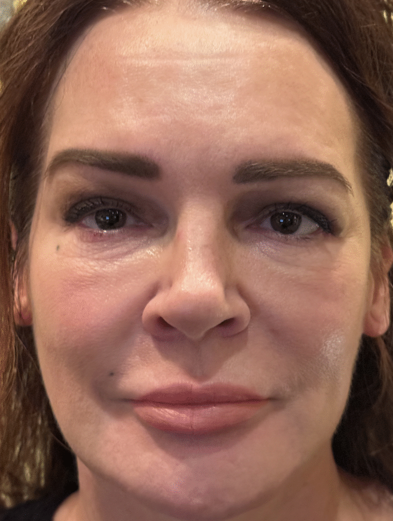 FULL FACE FRACTIONAL ABLATIVE CO2 Before