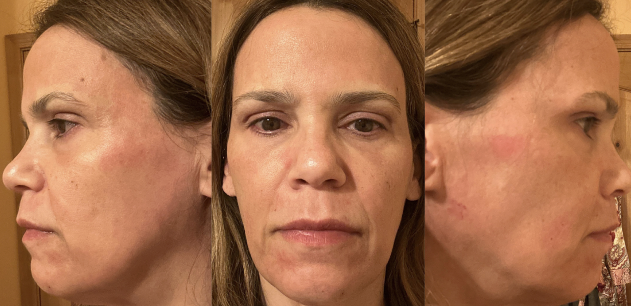 Laser Skin Resurfacing - Fractional CO2 laser Full Face including Upper & Lower Eyelids After