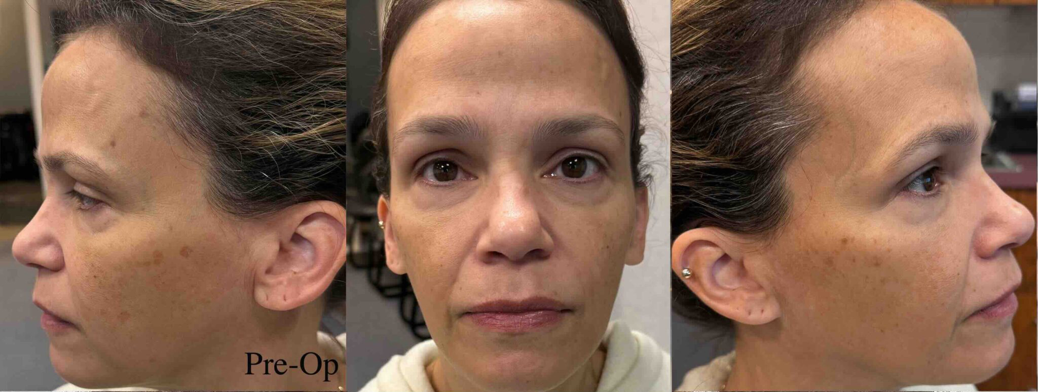 Laser Skin Resurfacing - Fractional CO2 laser Full Face including Upper & Lower Eyelids Before