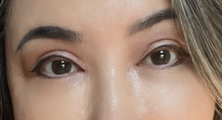 Medial Epicanthoplasty to Reduce 'Mongolian Fold' After