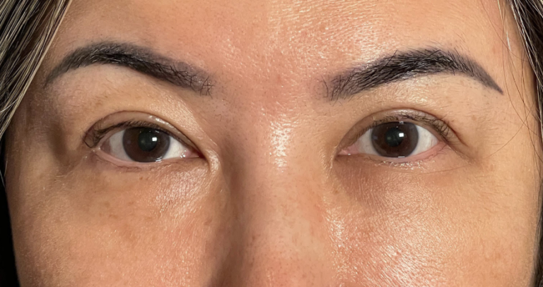 Medial Epicanthoplasty to Reduce 'Mongolian Fold' Before