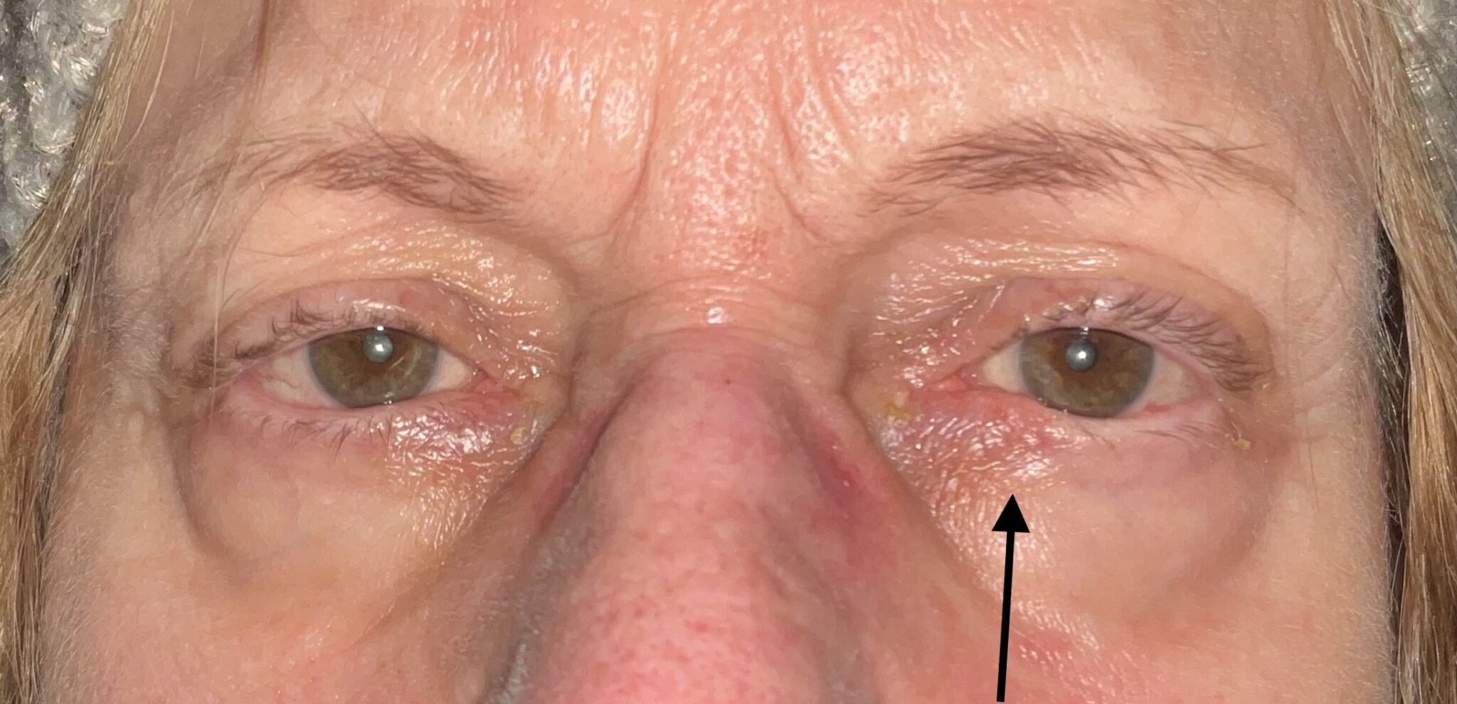 Mohs Surgery for Skin Cancer Reconstruction of Eyelid After