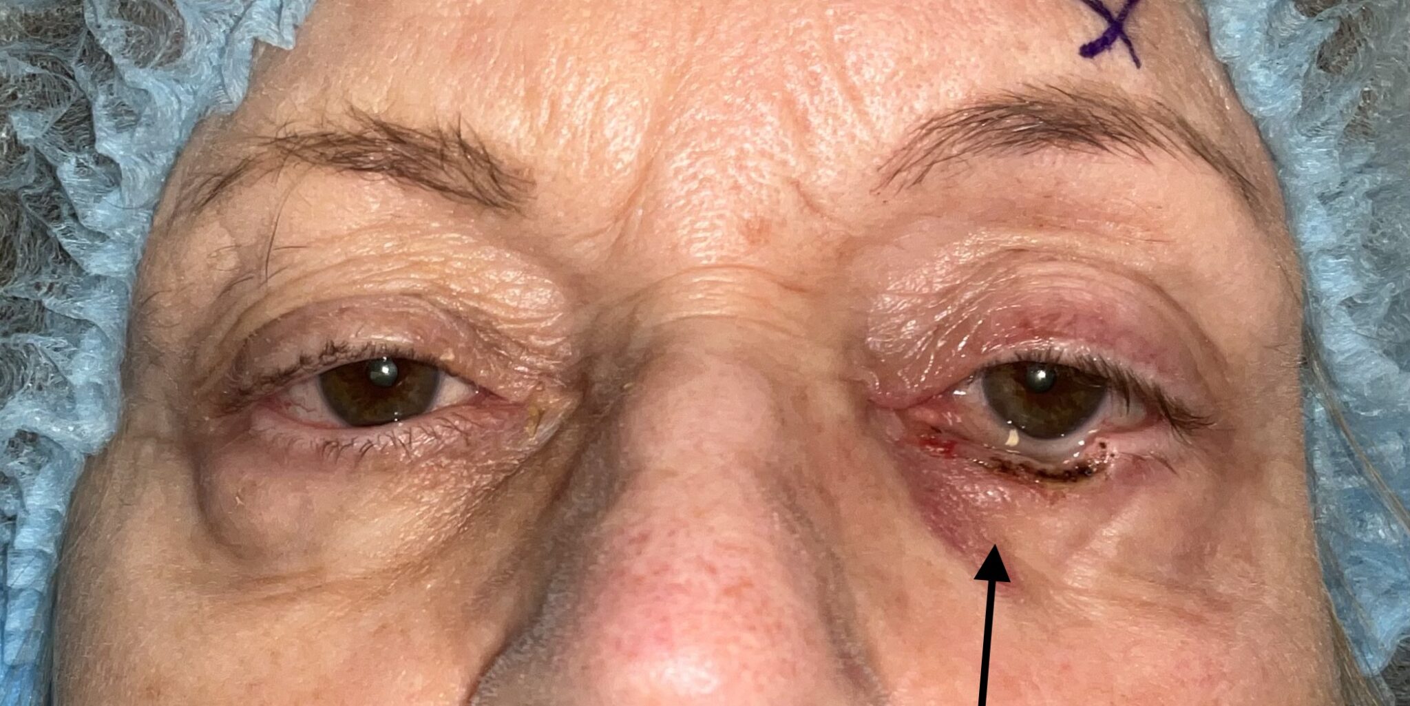 Mohs Surgery for Skin Cancer Reconstruction of Eyelid Before