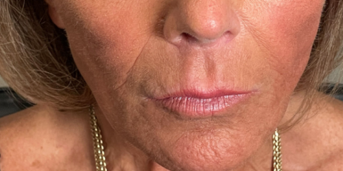 Lip fillers to straighten and symmetrize upper lips After