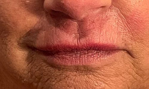 Lip filler with Restylane Silk Before