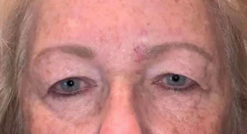Upper Lid Blepharoplasty Before