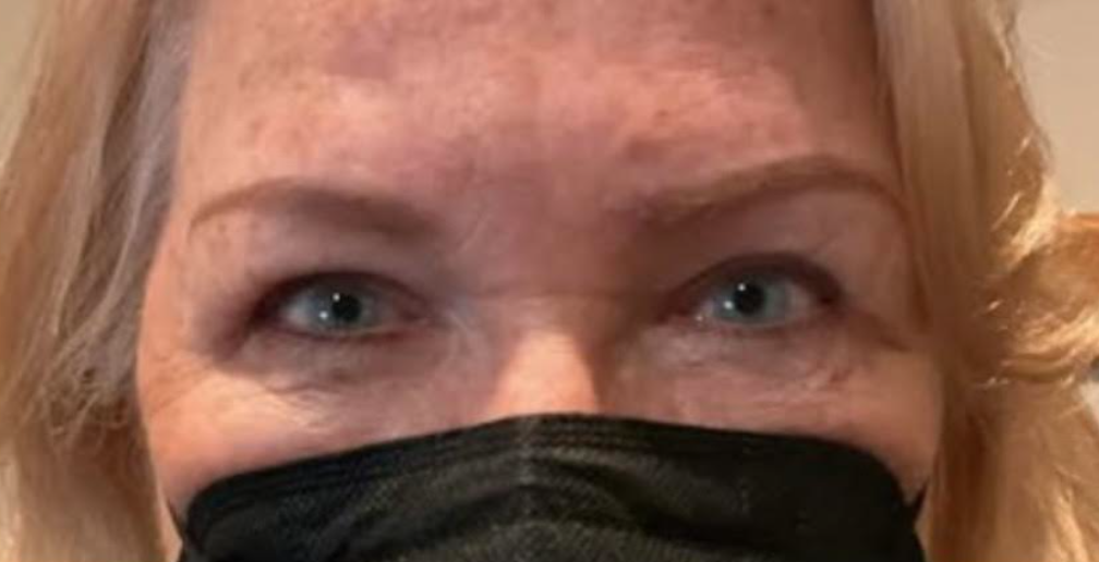 Upper Lid Blepharoplasty After