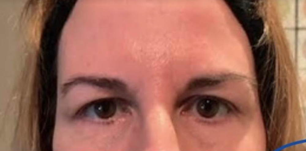 Upper Lid Blepharoplasty Before
