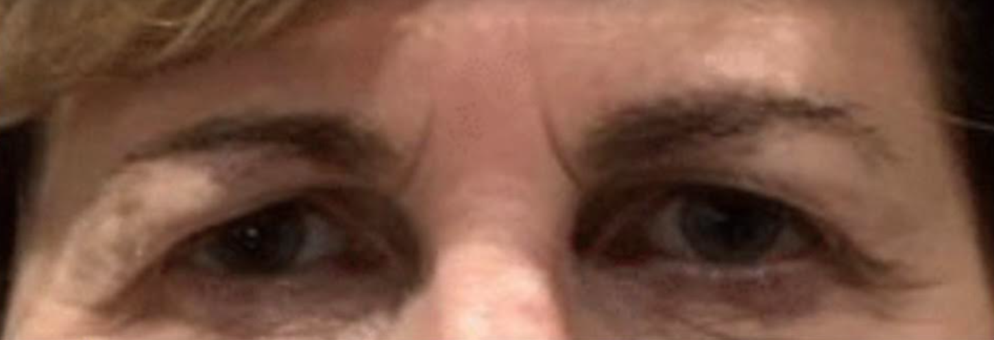 Upper Lid Blepharoplasty Before