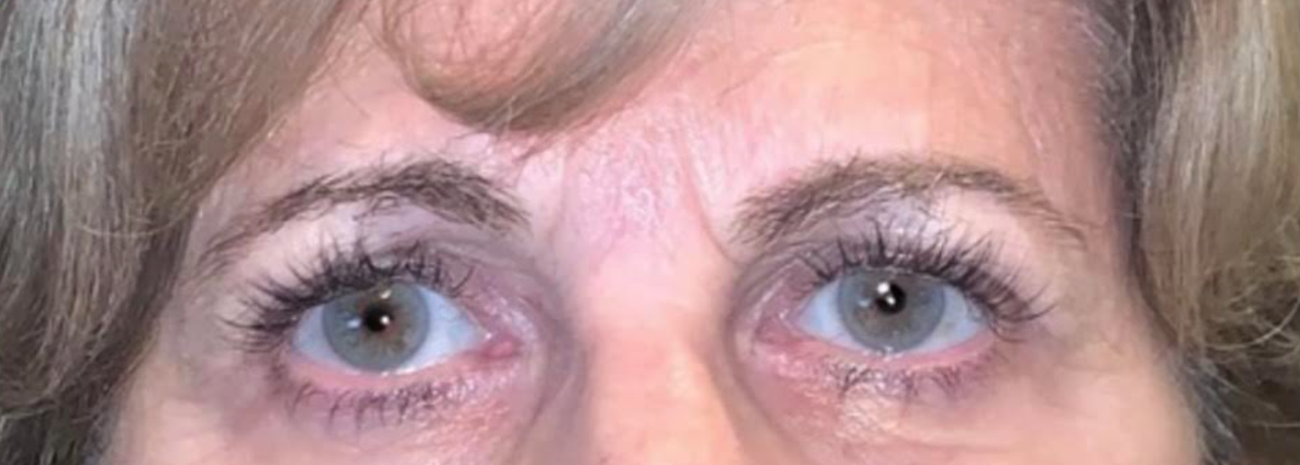 Upper Lid Blepharoplasty After