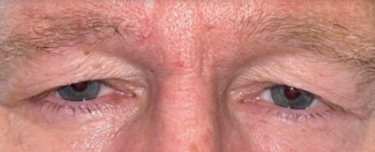 Upper Lid Blepharoplasty Before