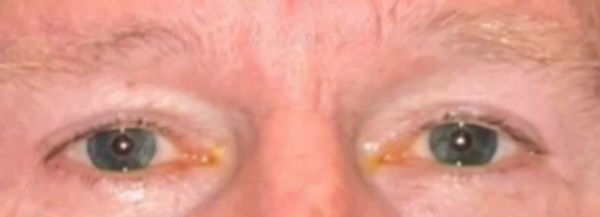 Upper Lid Blepharoplasty After