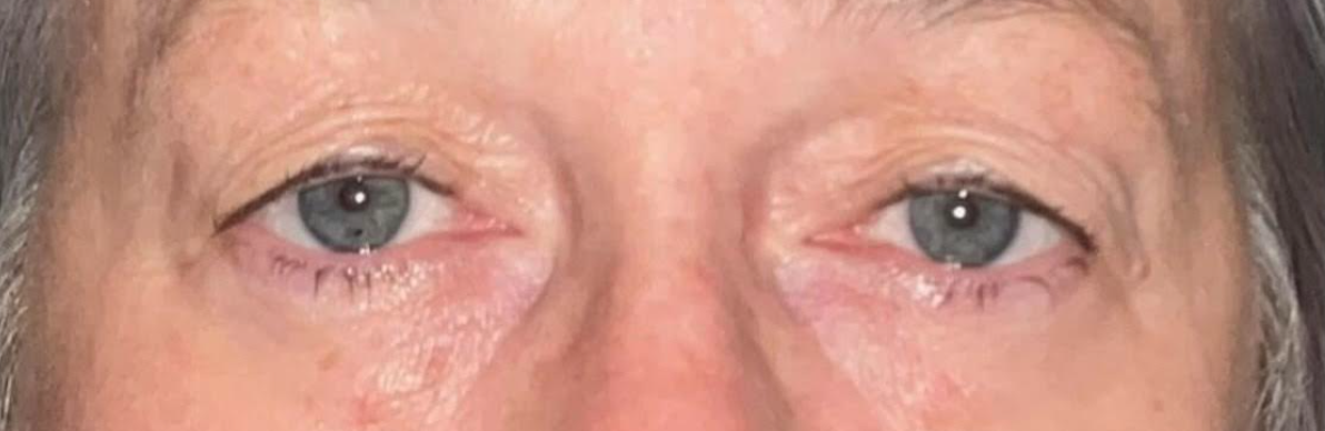 Upper Lid Blepharoplasty Before