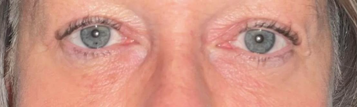Upper Lid Blepharoplasty After