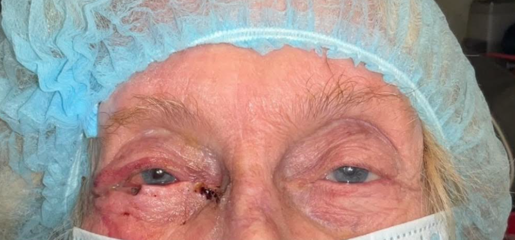 Mohs Surgery for Skin Cancer Reconstruction of Eyelid Before