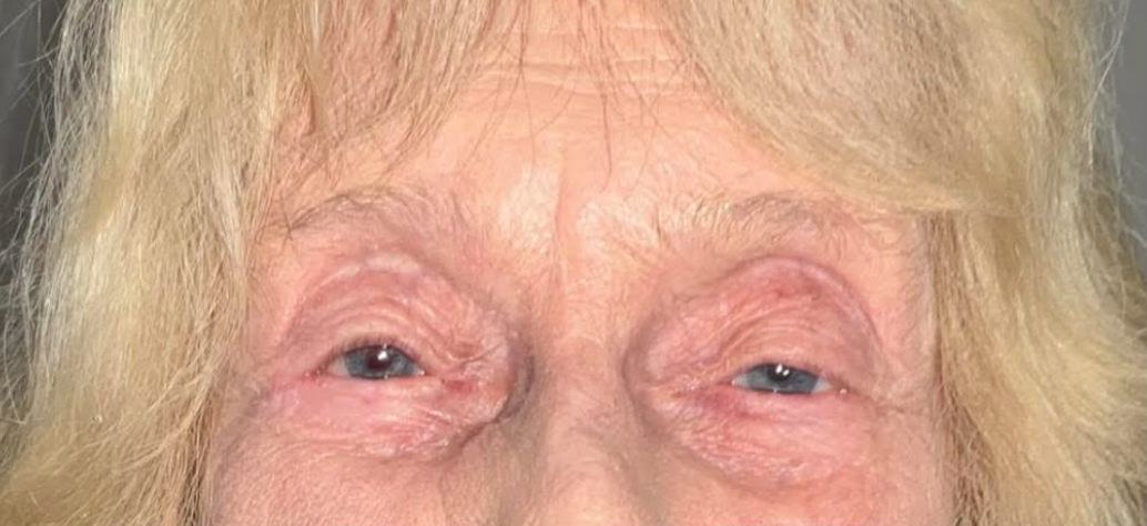 Mohs Surgery for Skin Cancer Reconstruction of Eyelid After