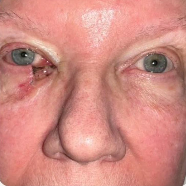 Mohs Surgery for Skin Cancer Reconstruction of Eyelid Before