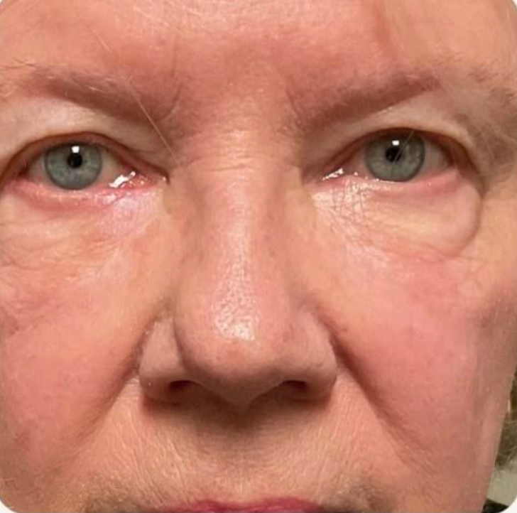 Mohs Surgery for Skin Cancer Reconstruction of Eyelid After