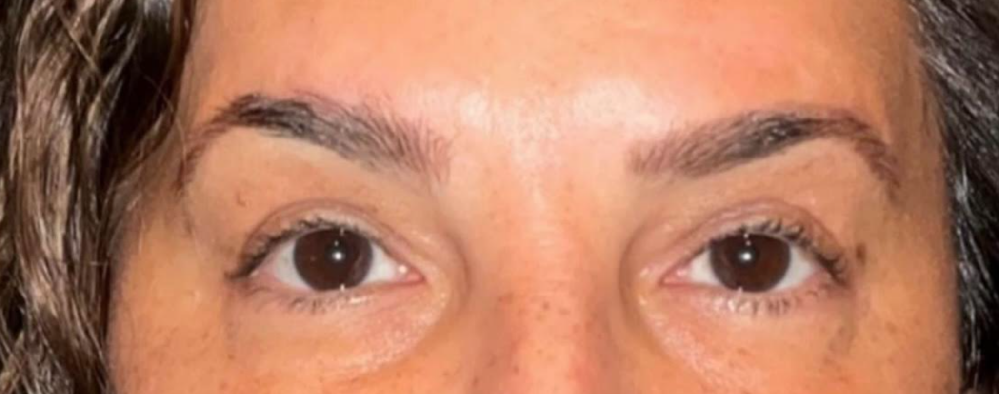 Brow Lift After