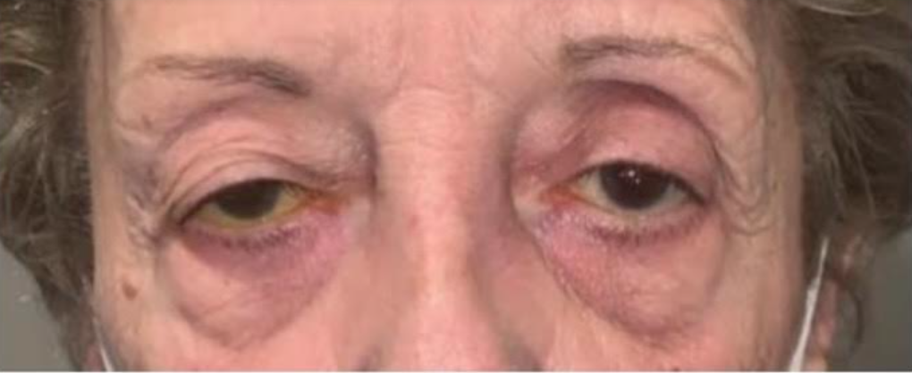Ptosis Repair Before