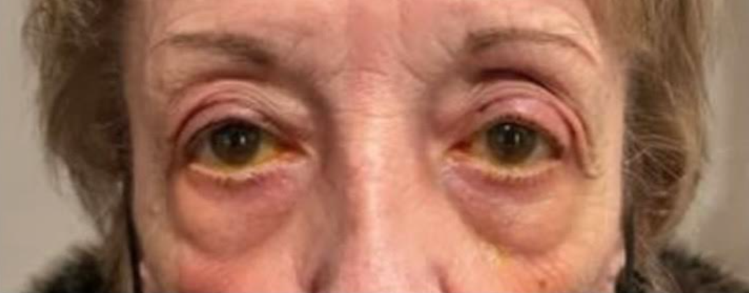 Ptosis Repair After