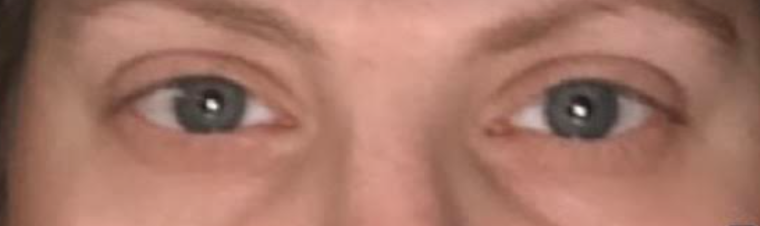 Under Eye Filler Before