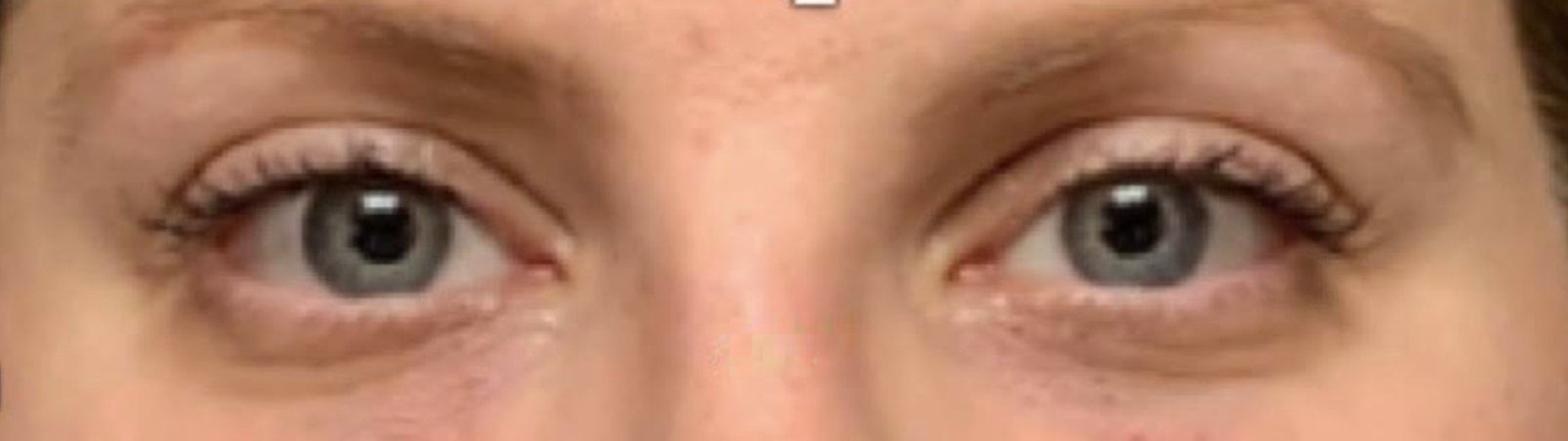 Under Eye Filler After