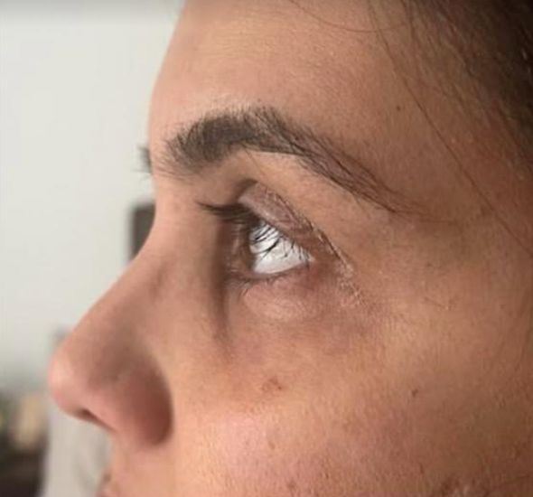 Under Eye Filler Before