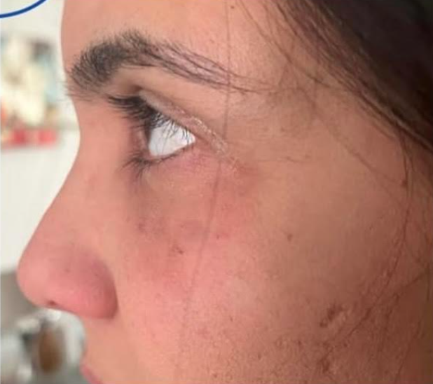 Under Eye Filler After