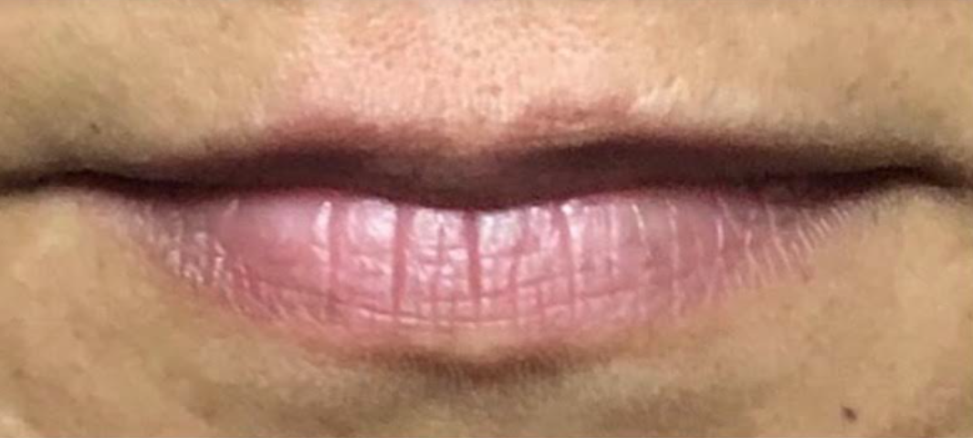 Lip Filler Treatment Before
