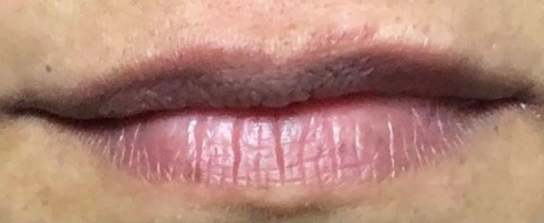 Lip Filler Treatment After