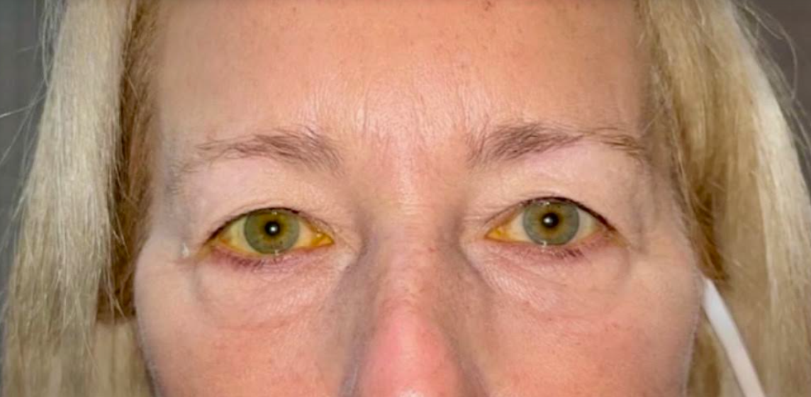 Upper and Lower Eyelid Blepharoplasty Before