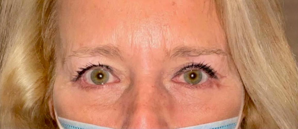Upper and Lower Eyelid Blepharoplasty After