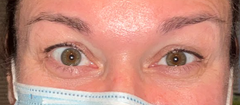 Botox Treatment After