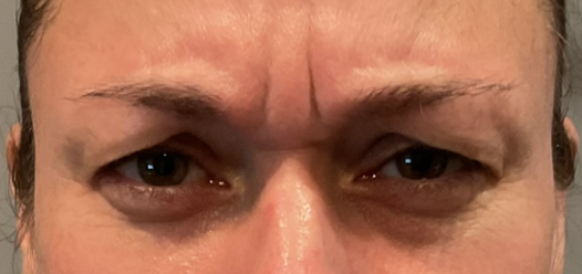 Botox Treatment Before
