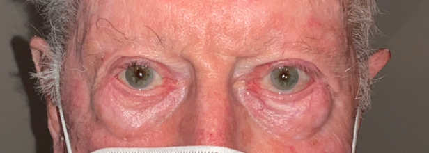 Ectropion Repair After