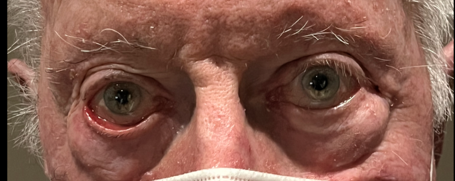 Ectropion Repair Before