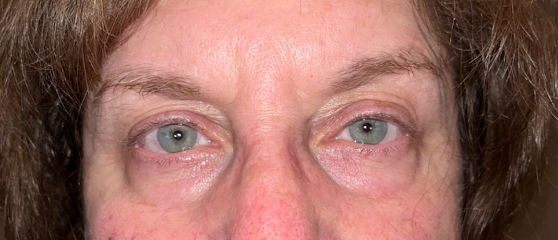 Lower Eyelid Blepharoplasty Before