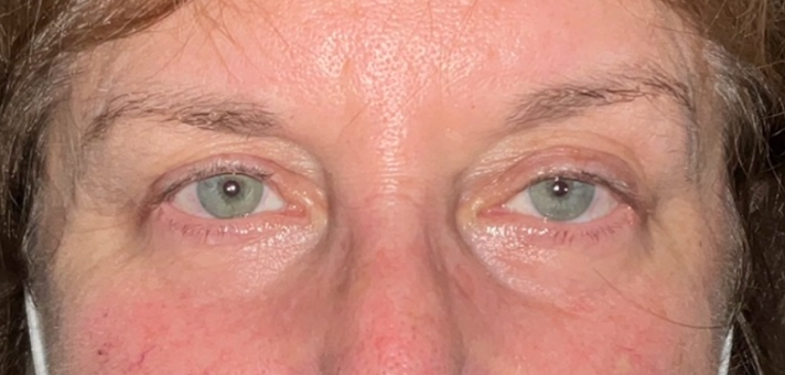 Lower Eyelid Blepharoplasty After