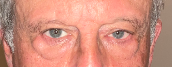 Lower Eyelid Blepharoplasty Before