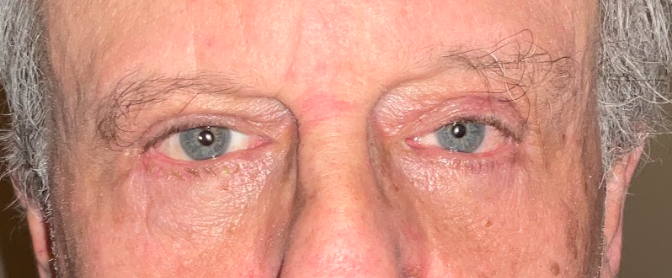 Lower Eyelid Blepharoplasty After